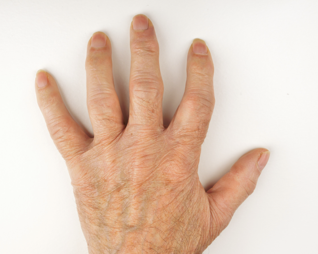 Hand Deformities