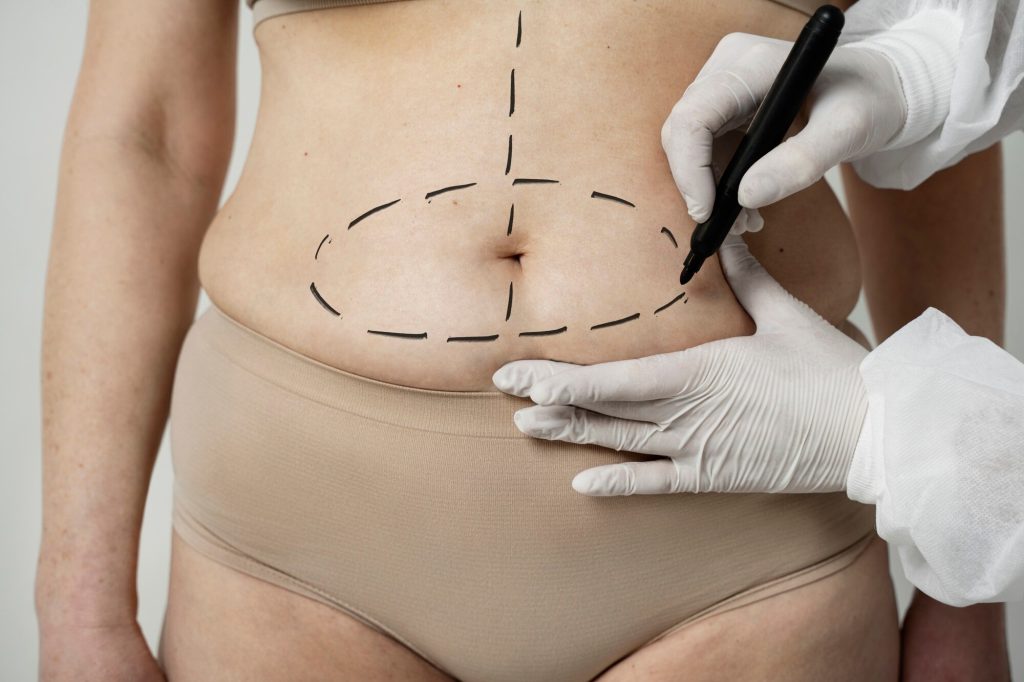 lipoabdominoplasty by dr mohan