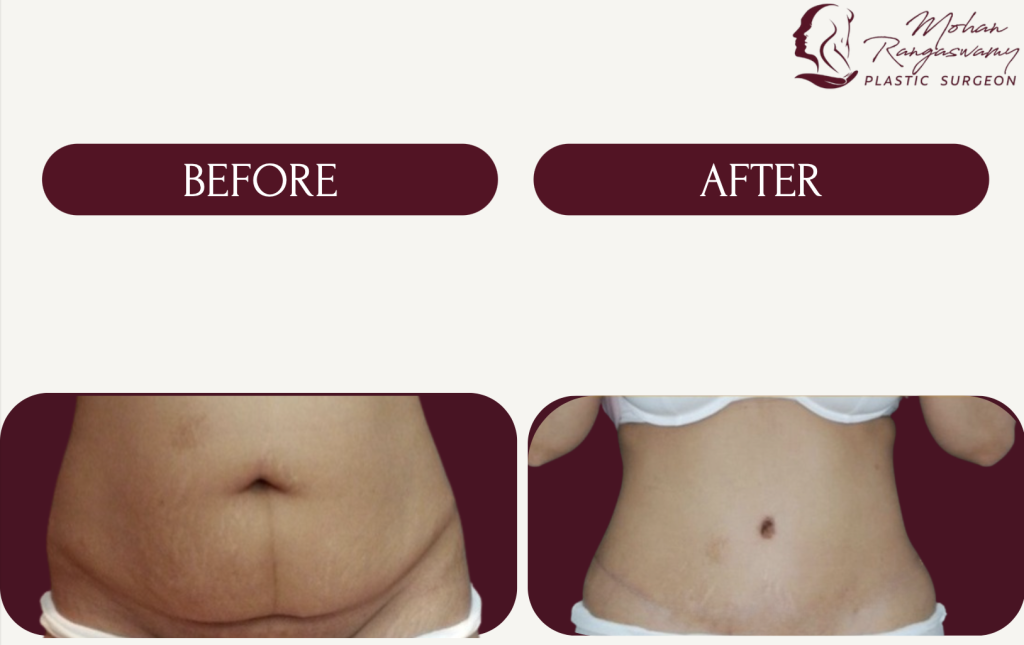 Abdominoplasty (Tummy Tuck) in Dubai​