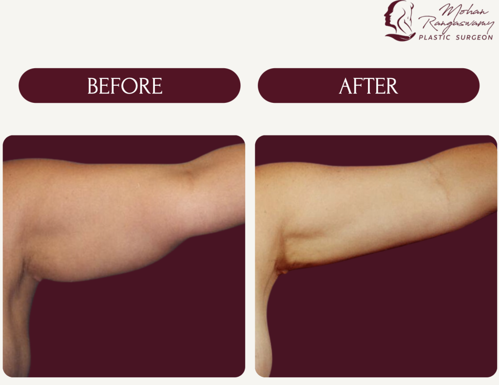 Achieve Toned Arms with Arm Lift and Liposuction in Dubai​