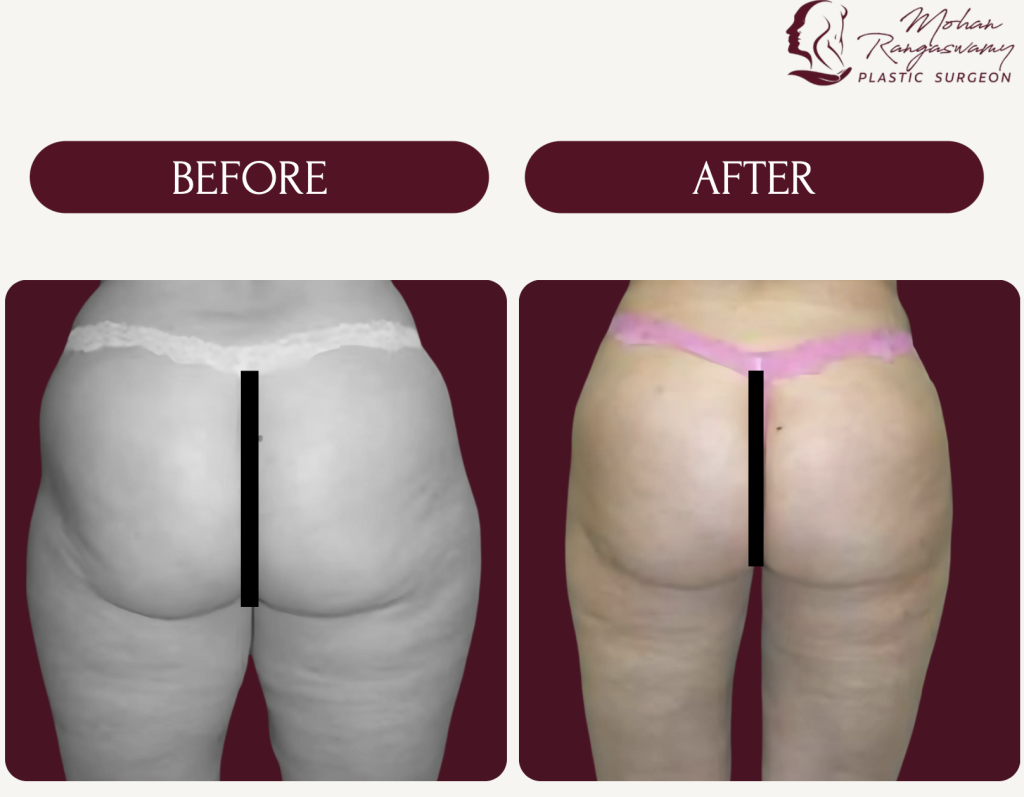 Brazilian Butt Lift Surgery in Dubai​