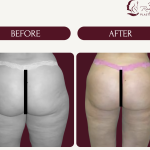 Brazilian Butt Lift Surgery in Dubai​