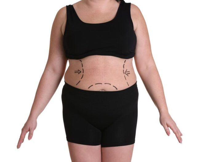 Post weight loss surgery UAE