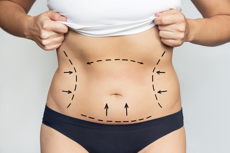 liposuction-vs-diet-and-exercise