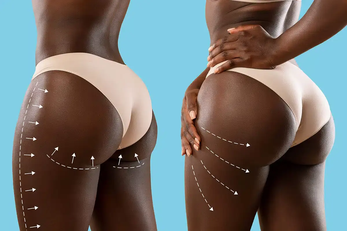safe-buttock-lift-treatment