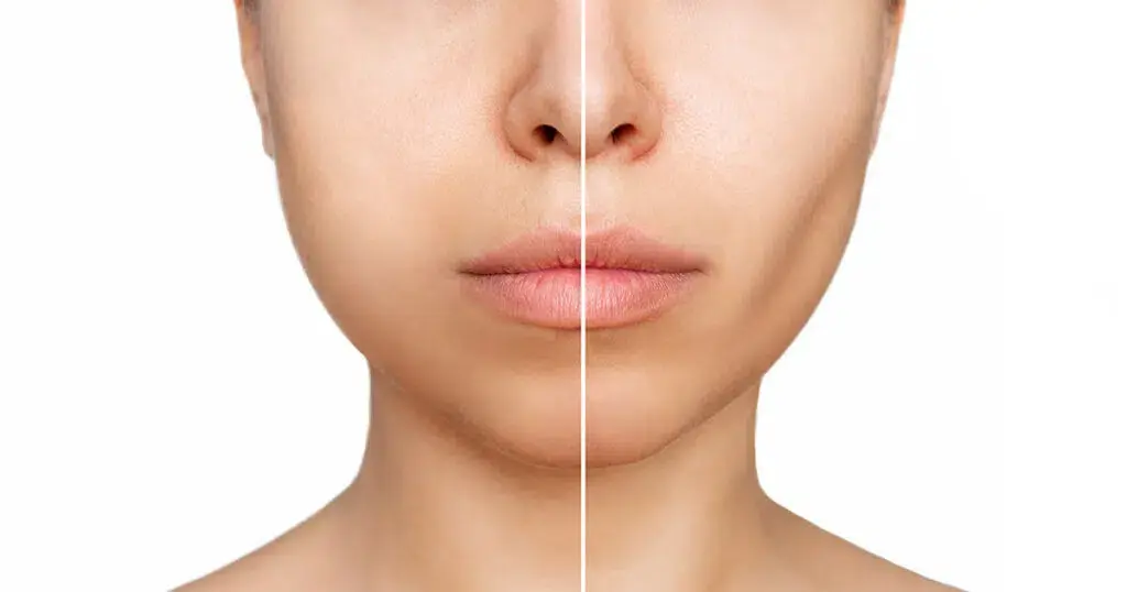 buccal-fat-removal