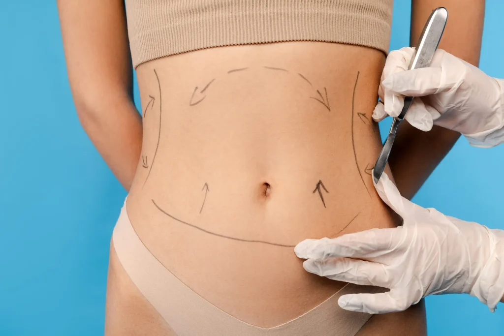 what-is-vaser-liposuction-for-abdomen