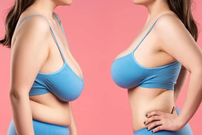breast-sagging