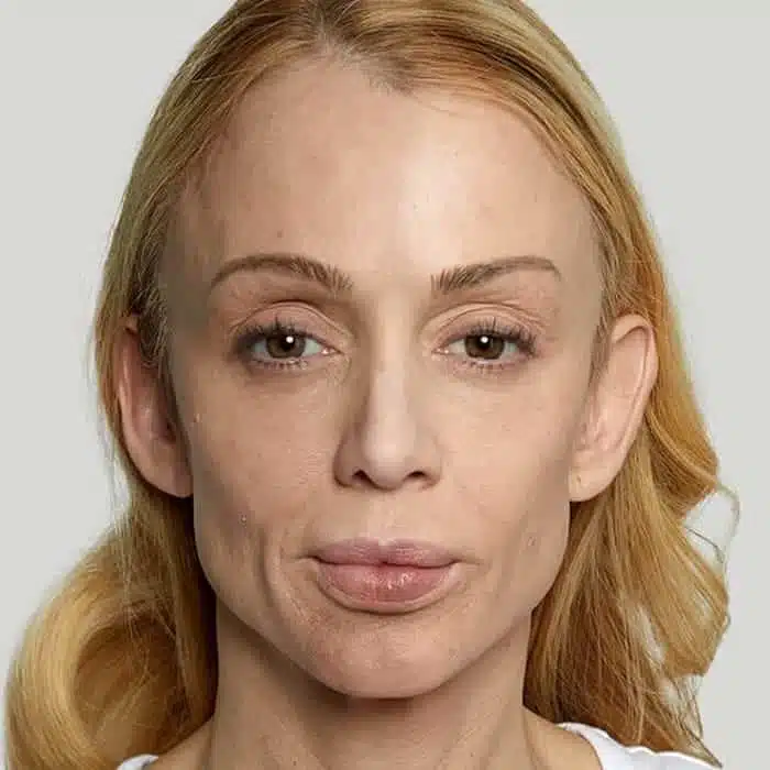 how-hollow-cheeks-affect-facial-balance