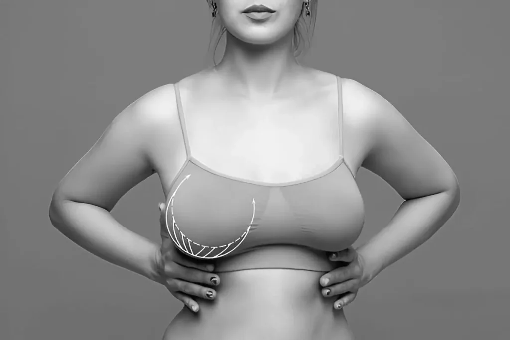 role-of-skin-elasticity-in-breast-sagging