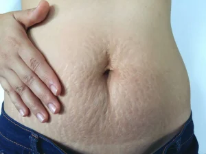stretch-marks-after-pregnancy