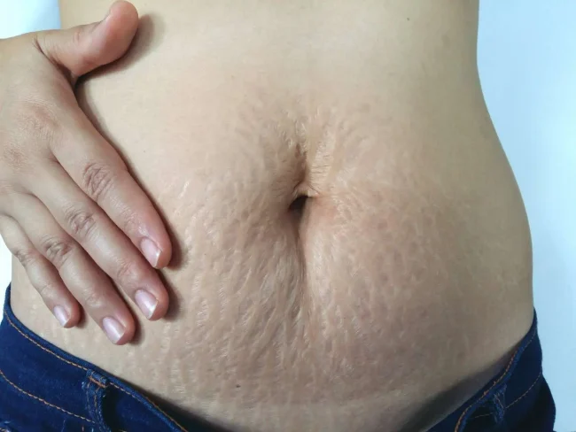 stretch-marks-after-pregnancy