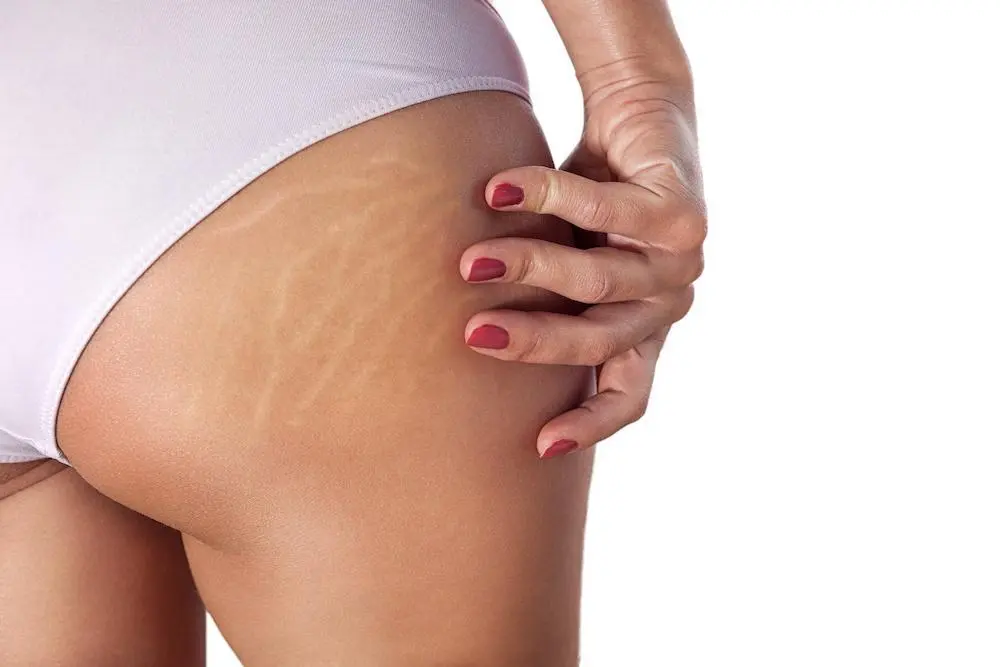 stretch-marks-after-pregnancy-on-hips-and-thighs