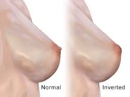 inverted-nipples