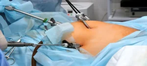 bariatric-surgery