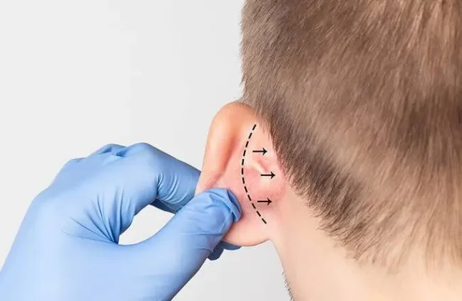 ear-correction-surgery ear-correction-surgery