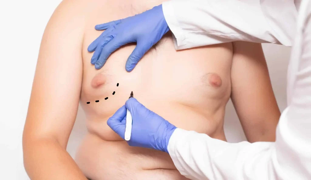 man-boobs-treatment