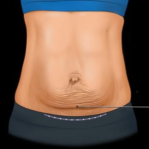 Lipoabdominoplasty